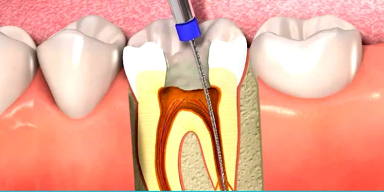 endodontia-no-butanta