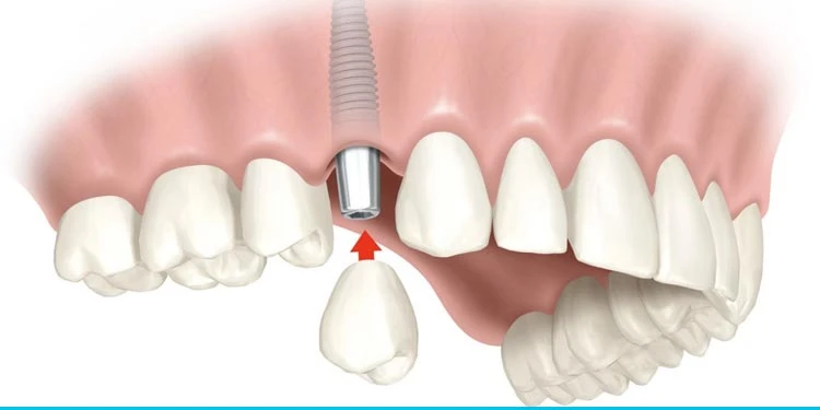 implantes-dentarios-no-butanta-em-sao-paulo